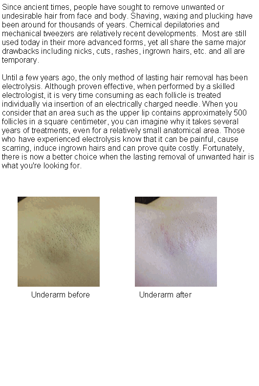 History of Hair Removal